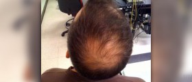 Causes of alopecia