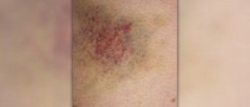 Causes of bruising