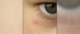 Causes of cherry angiomas