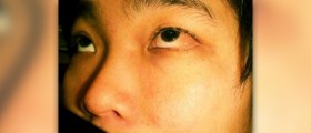 Causes of conjunctivitis
