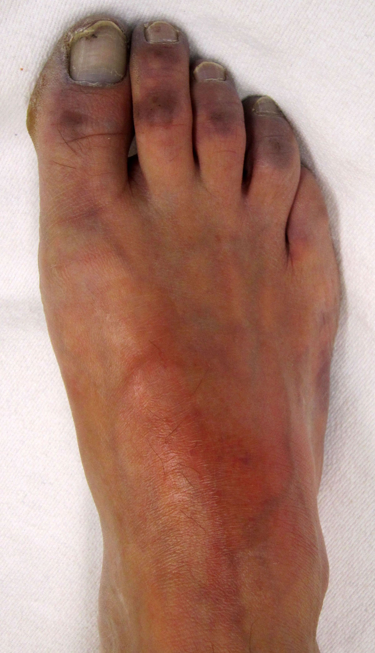 What Is Central And Peripheral Cyanosis