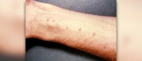 Causes of dermatitis