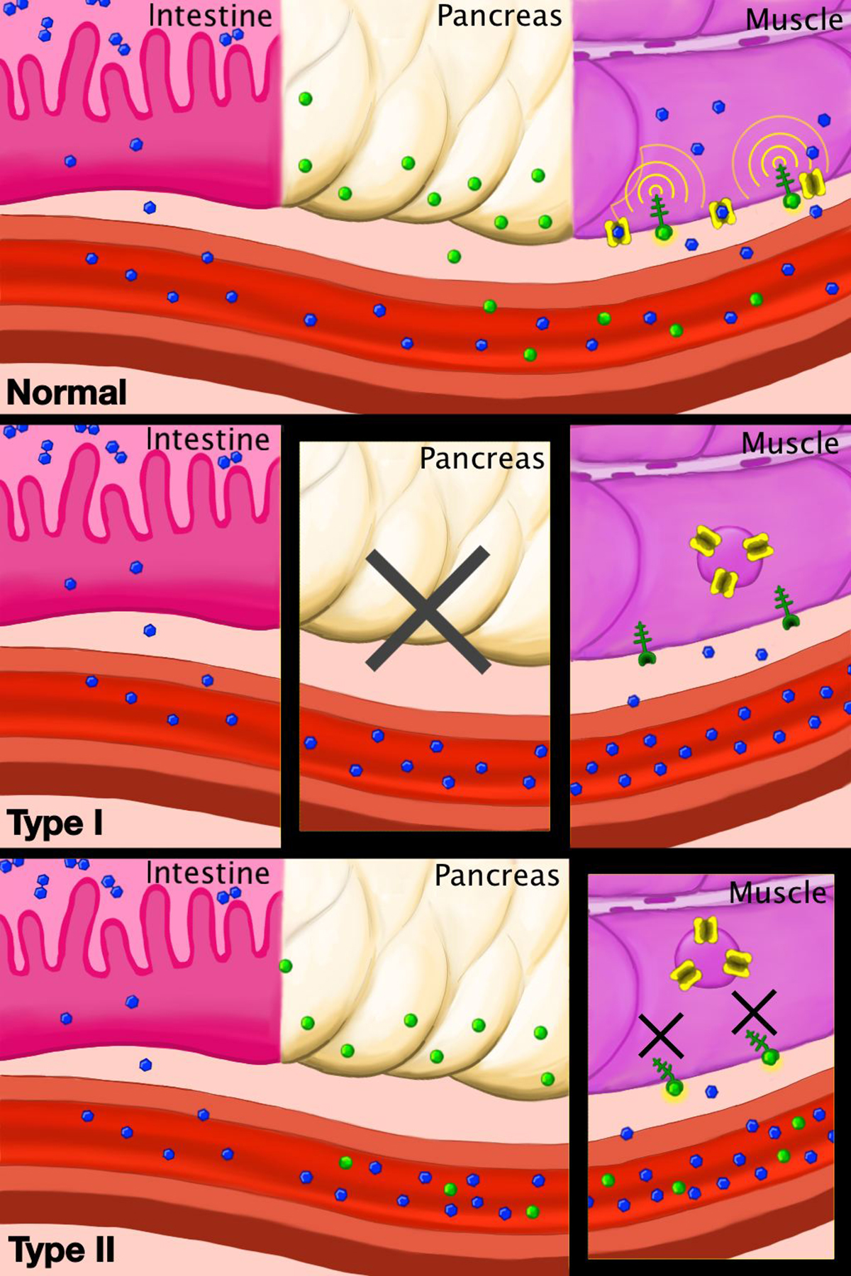 type 2 diabetes