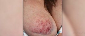 Causes of easy bruising