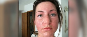 Causes of excessive head sweating