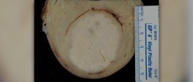 Causes of fibroids