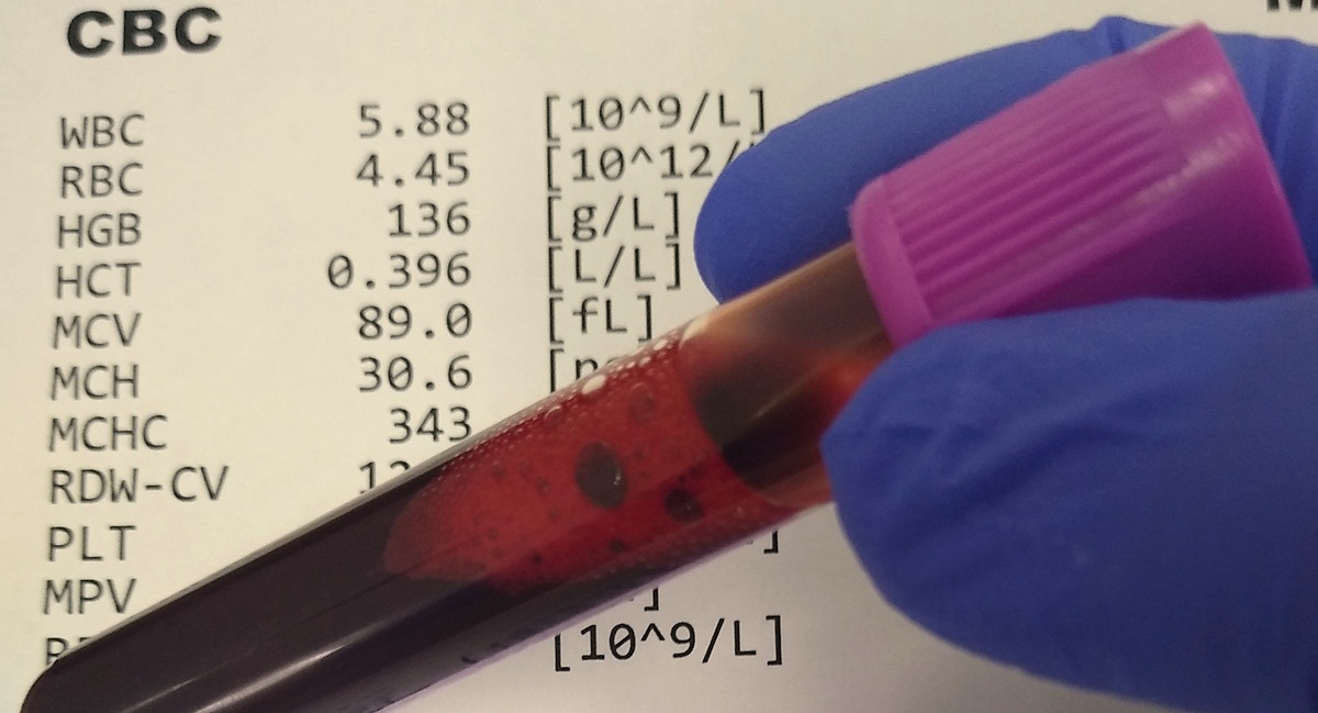 Causes of high platelet count General center