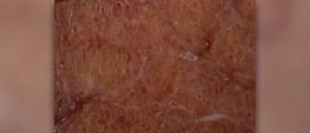 Causes of hyperthyroidism