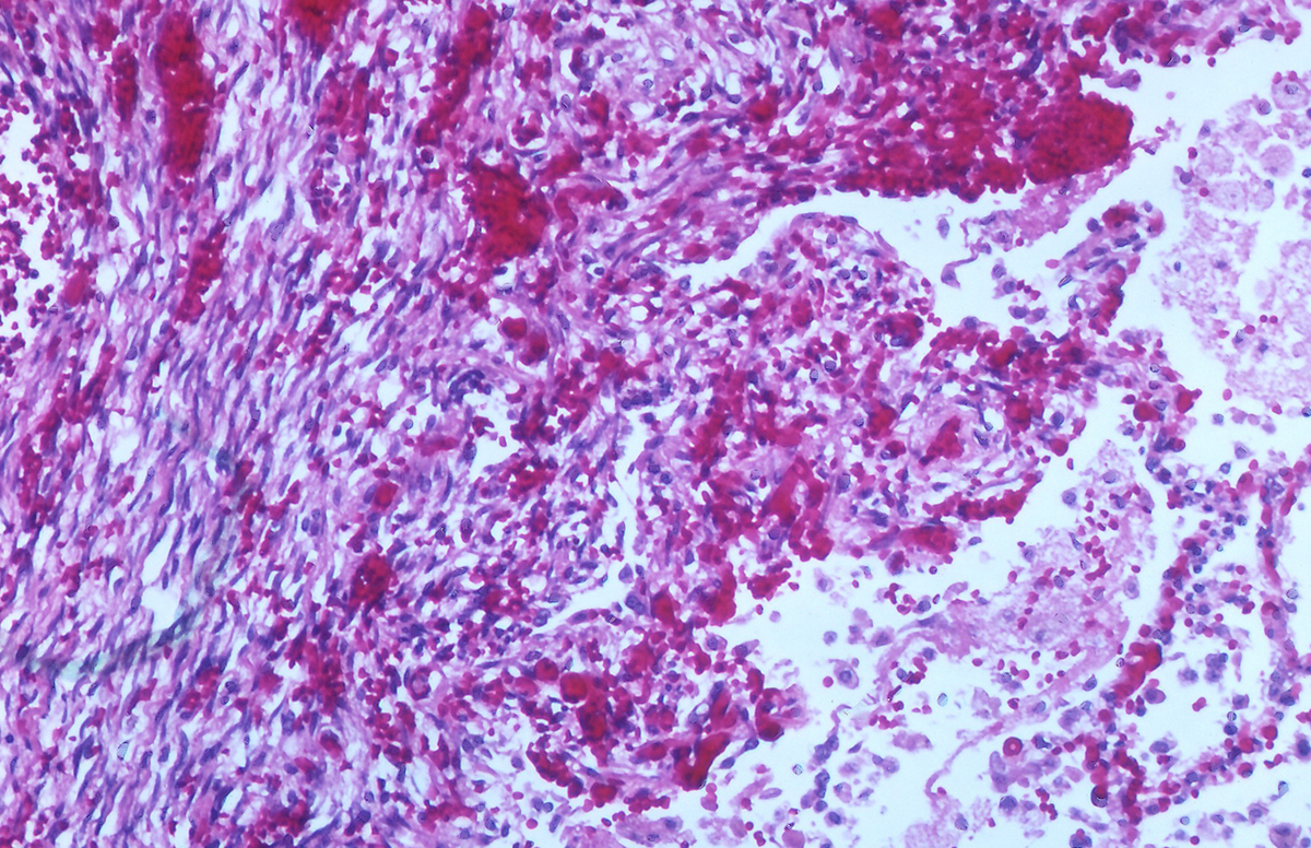 Causes Of Kaposis Sarcoma General Center