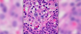 Causes of lymphoma