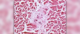 Causes of myocardial infarction