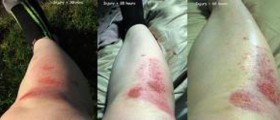 Causes of painful rash