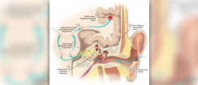 Causes of permanent hearing loss