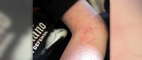 Causes of purpuric rash