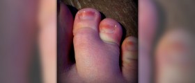 Causes of syndactyly