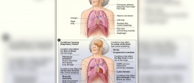 Causes of type 2 respiratory failure