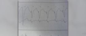 Causes of ventricular tachycardia