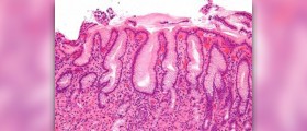 Causes, symptoms and treatment for gastritis