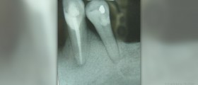 Causes, symptoms and treatment for periodontal disease