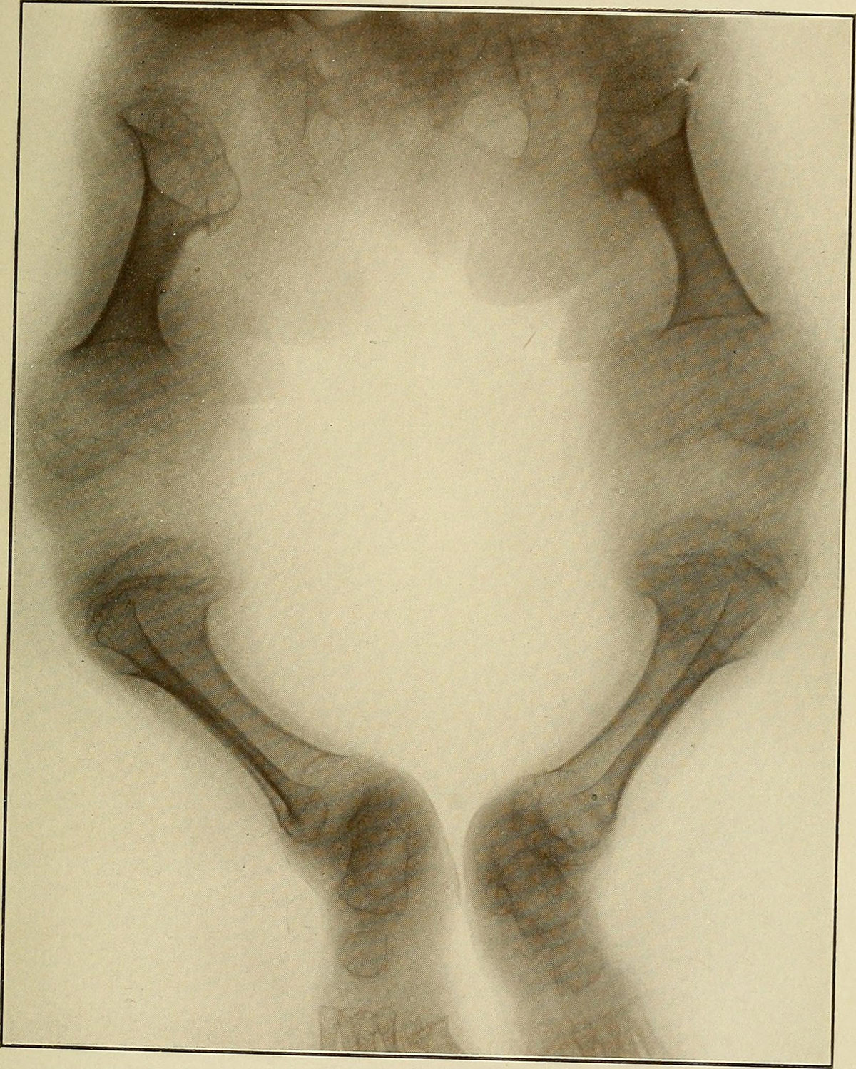 Causes Symptoms And Treatments For Achondroplasia General Center