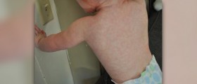 Causes, treatment and prevention for roseola