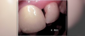 Cavity causes and symptoms
