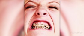 Ceramic braces vs metal braces