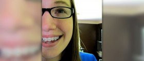 Ceramic orthodontic braces