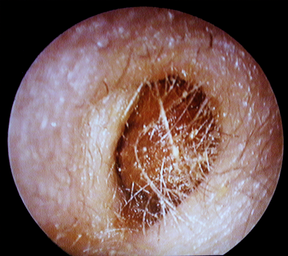 removal of adrenal glands