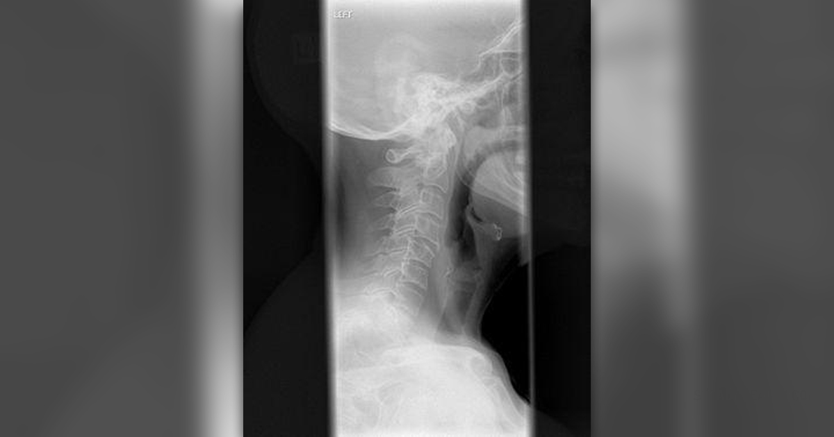 Cervical Kyphosis Review 