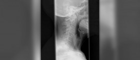 Cervical kyphosis review