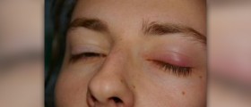 Chalazion surgery facts