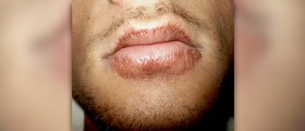 Chapped lips causes