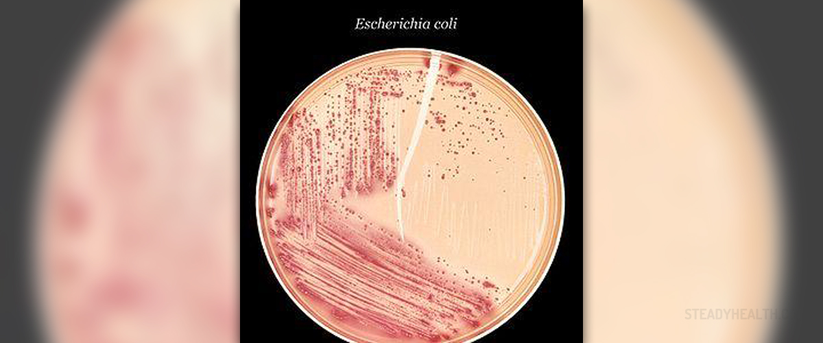 Characteristics of Escherichia coli diagnosis | Body & Health