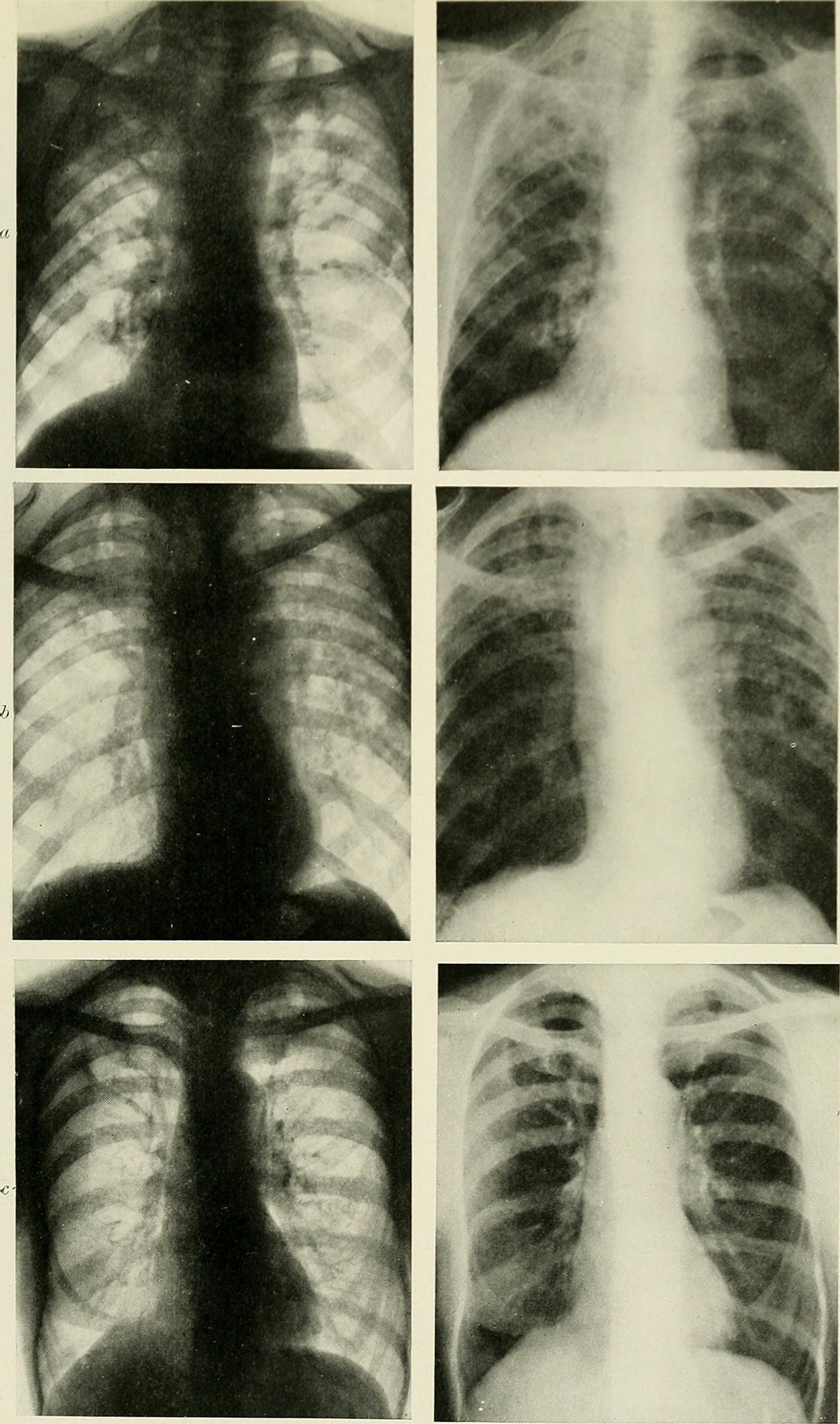 Chest congestion treatment | General center | SteadyHealth.com