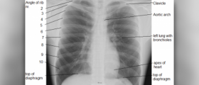 Chest hurts when breathing