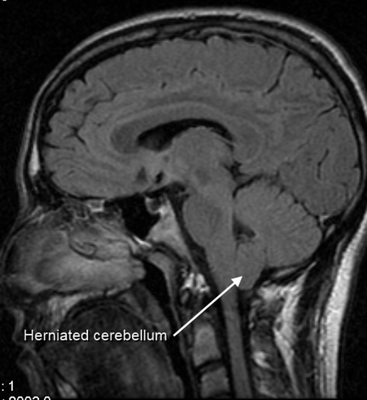 Chiari malformation symptoms | General center | SteadyHealth.com