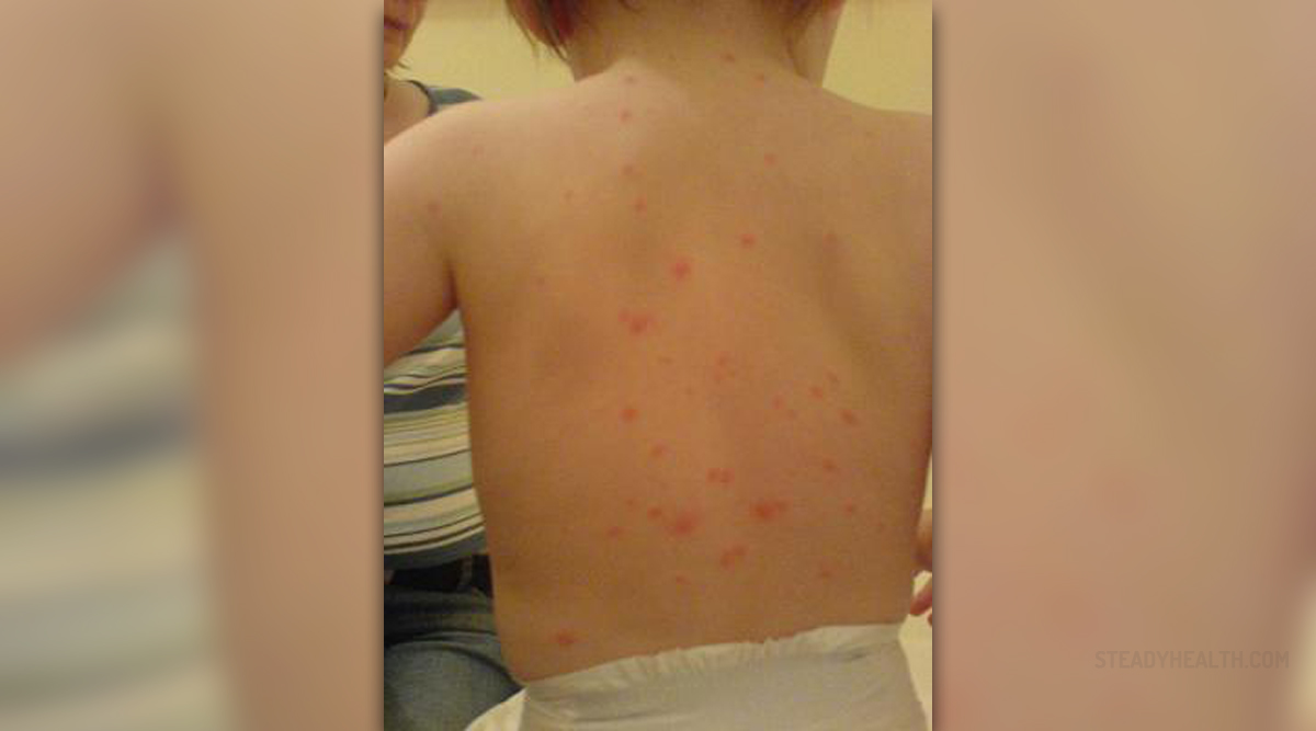 Chickenpox vaccine complications | General center | SteadyHealth.com