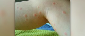 Chigger bite symptoms