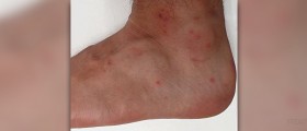 Chigger bite treatment