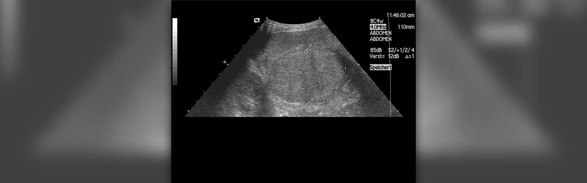 Enlarged liver in children | General center | SteadyHealth.com