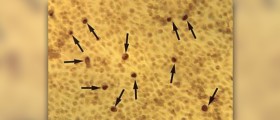Chlamydia in men