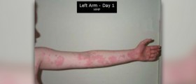 Cholinergic urticaria treatment