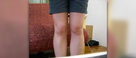 Chondromalacia: Runner's knee