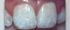 Choosing a dental crown