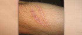 Choosing the right scar removal product