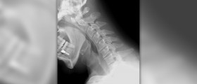 Chronic cervical myelopathy