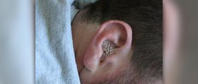 Chronic ear infections