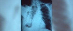 Chronic fibrosing alveolitis