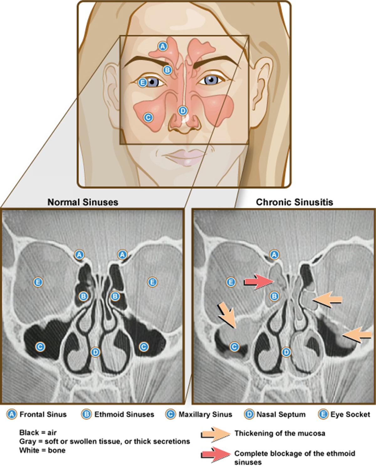 Meningitis A Sinusitis